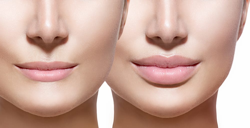 Lip fillers Revolutionizing the aesthetic industry-thatviralfeedcdn